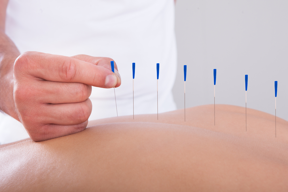What to expect at fertility acupuncture
