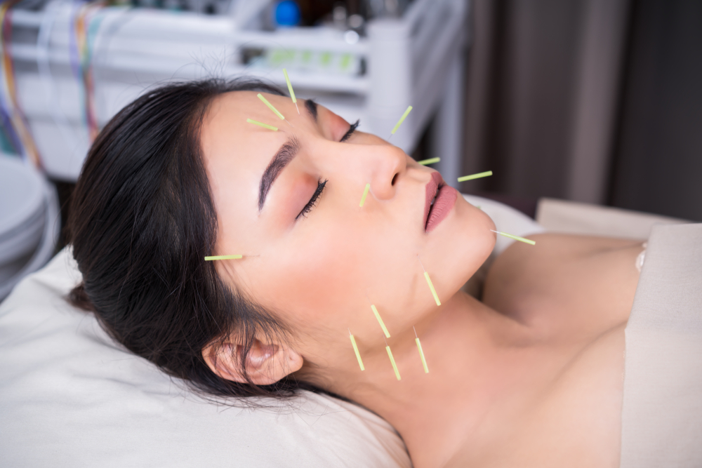 Acupuncture for Pain Relief: An Alternative Approach