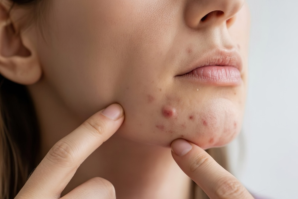 adult acne and why its more than just a skin issue