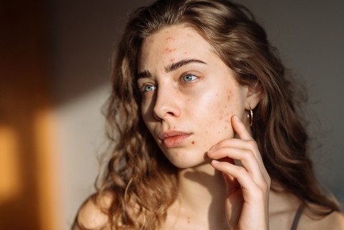 Could my diet be contributing to acne