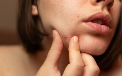 What Your Acne Is Trying to Tell You About Your Health