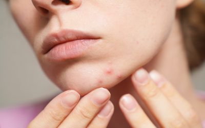 Hormonal Acne Explained: A Root‑Cause Perspective