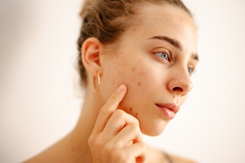 Why dont topical treatments fix chronic acne
